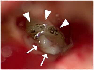 Practicality of multilayer round window reinforcement in the surgical management of superior semicircular canal dehiscence syndrome: a case report of long-term follow-up